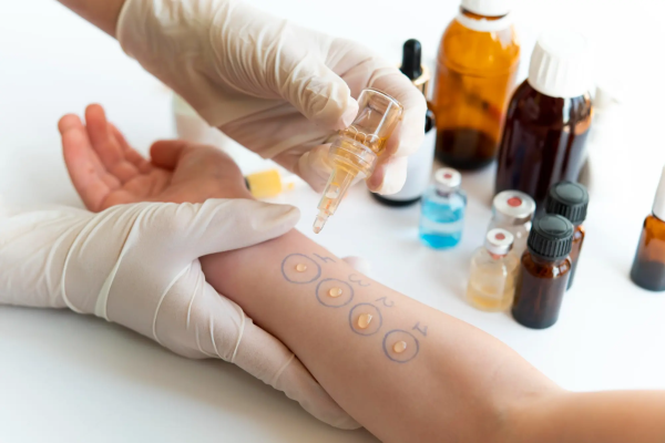 Allergy Skin Prick and Intradermal Testing