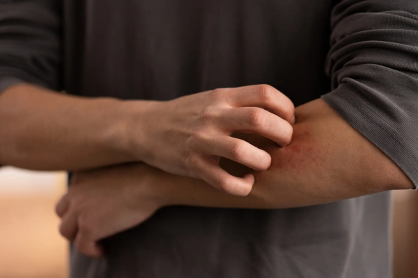 Eczema (atopic dermatitis)
