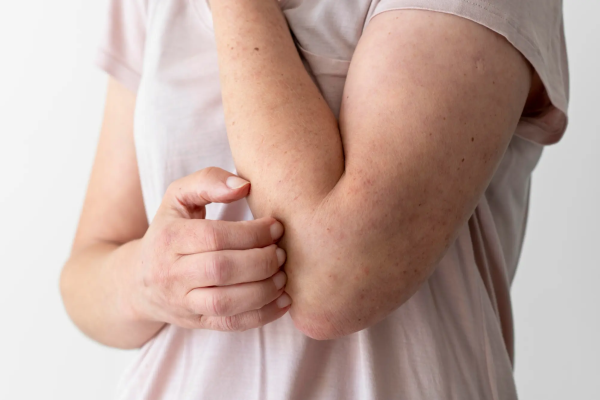 Stinging Insect Allergy