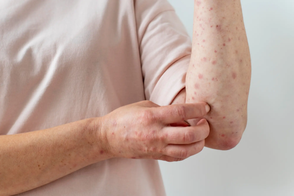 Urticaria (Hives)